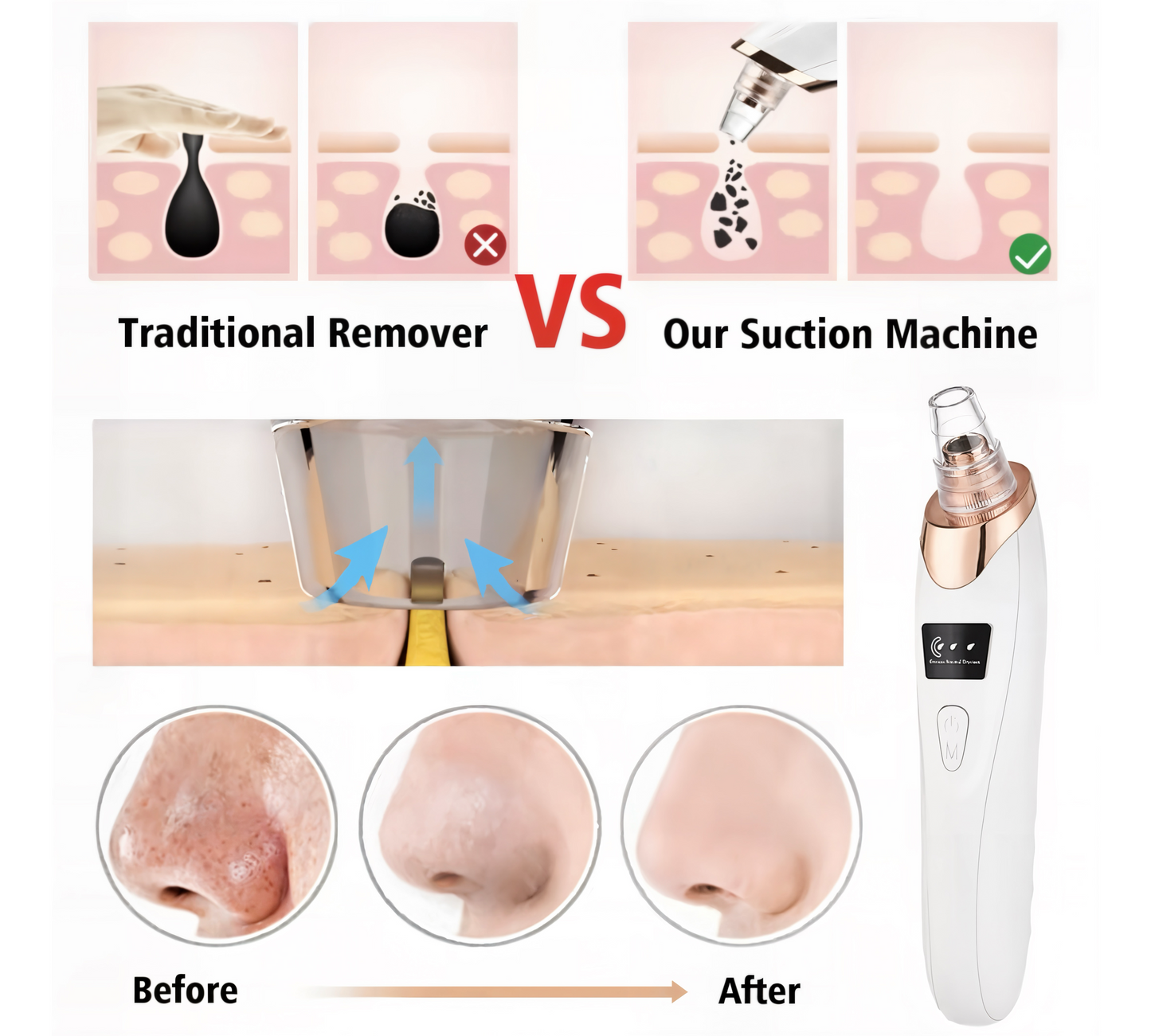 PoreVac ProM™- Rechargeable Pore Vacuum Cleanser